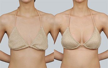 Унжсан хөх өргөх мэс засал