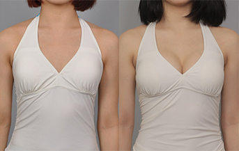 Хөхний давтан мэс засал