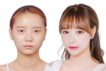 Бамби нүдний мэс засал