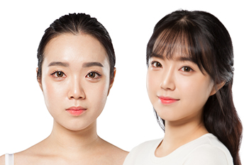 Зүсэлтгүй төрөлхийн мэт давхрааны мэс засал