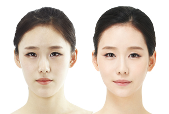 Зүсэлттэй давхрааны мэс засал