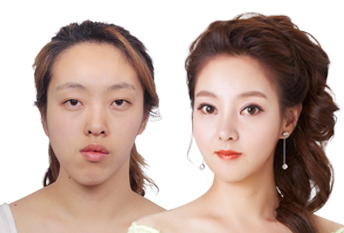 Хэсэгчилсэн зүсэлттэй давхрааны мэс засал