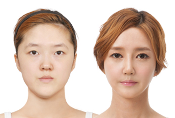 Нүд нээх булчин чангалах мэс засал