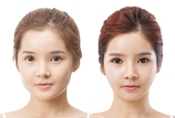 Нүдний давтан мэс засал