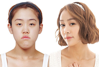 MVT Дөрвөлжин эрүү багасгах мэс засал