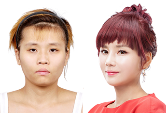 Урт нүүр богиносгох V-line мэс засал