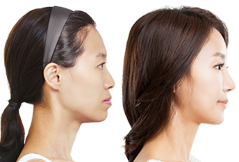 Хиймэл биет ашиглах духны мэс засал