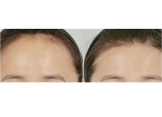 Үсний шугамаар дух багасгах мэс засал