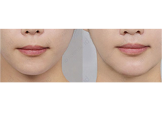 Хамар, уруул хоорондын зайг багасгах мэс засал