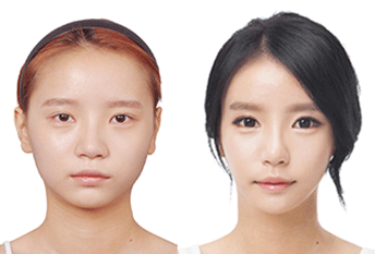 Кабин хамрын мэс засал