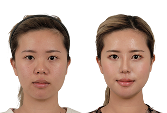 C-Point Хамрын үзүүр засах мэс засал