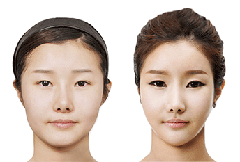 Хамрын давтан мэс засал