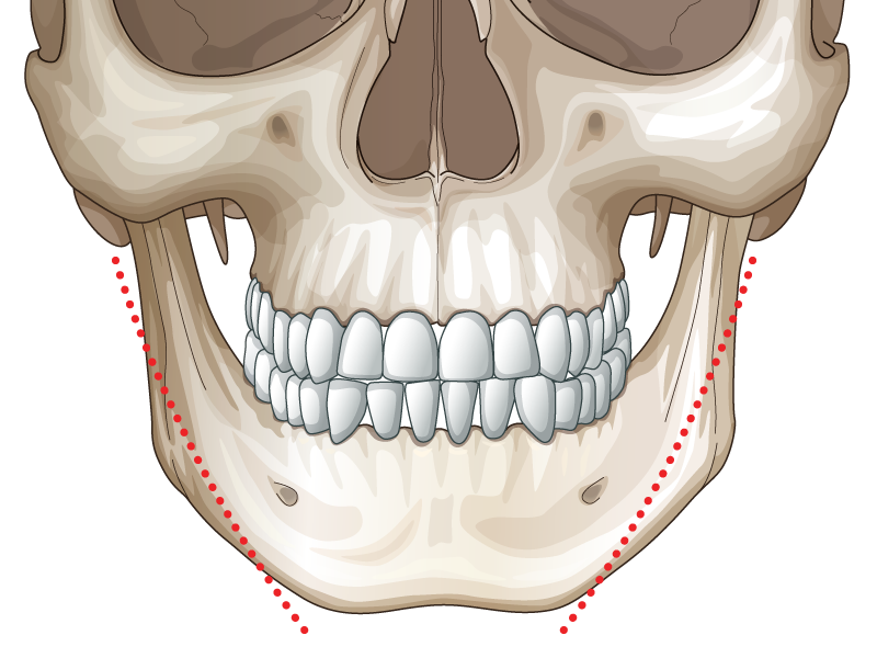 V line дөрвөлжин эрүүний мэс засал Чихний үзүүрт хийгддэг дөрвөлжин