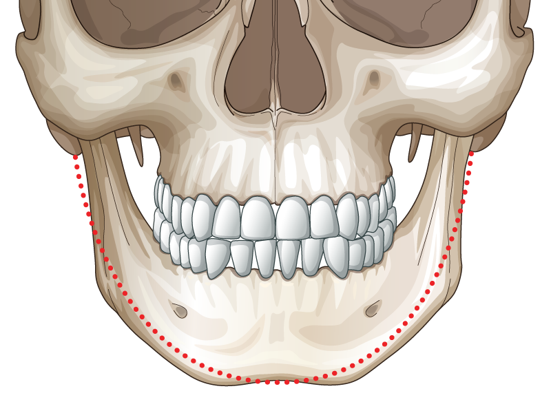 V line дөрвөлжин эрүүний мэс засал Эрүүг тойруулж багасгадаг