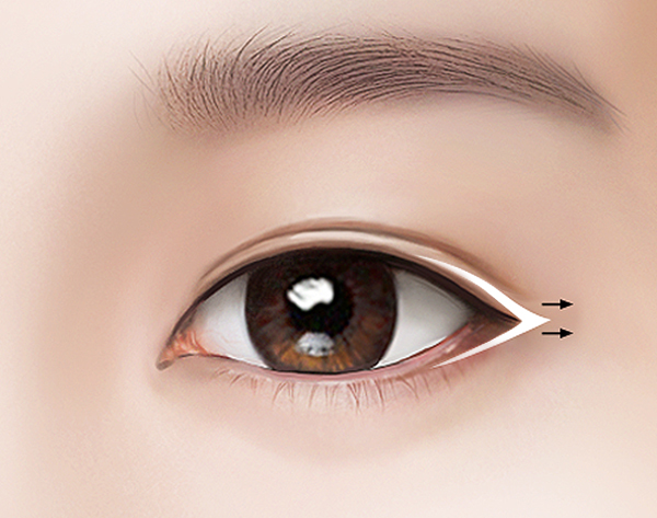 Нүдний хавсарсан сэтлэгээ Нүдийг хойш сэтлэх