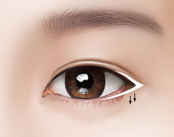 Нүдний хавсарсан сэтлэгээ Нүдийг доош нь сэтлэх