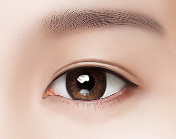 Зүсэлттэй давхрааны мэс засал Нарийн зүсэлтийн арга