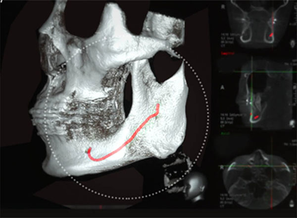 MVT Дөрвөлжин эрүү багасгах мэс засал Мэдрэлийн