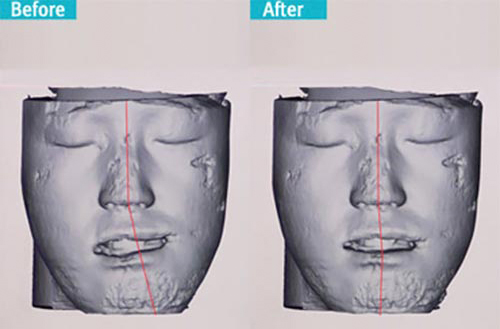 Эрүүний гажиг засах мэс засал технологио тасралтгүй