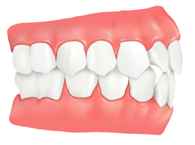 Товгор амны мэс засал Буйлнаас үүдэлтэй