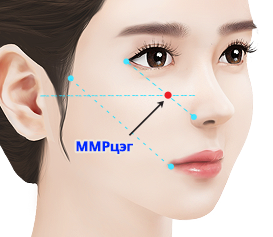 High L зүсэлтээр шанаа багасгах мэс засал уруулын төгсгөлийг