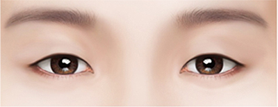 Нүдний давтан мэс засал Давхрааны зураас задарсан бол