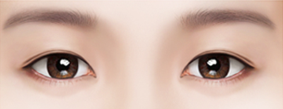 Нүдний давтан мэс засал Давхраа хэт нимгэн бас доор байвал