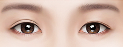 Нүдний давтан мэс засал Баруун зүүн нүдний давхраа хоёр өөр хийгдсэн бол