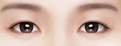 Нүдний давтан мэс засал Нүдний ухархайнд сорви үлдсэн бол