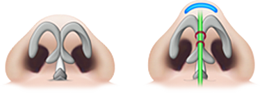 C Point Хамрын үзүүр засах мэс засал тулд найдвартай бэхэлж