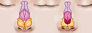 C Point Хамрын үзүүр засах мэс засал Хамрын үзүүрийг дээш