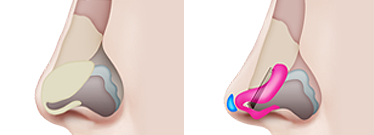 C Point Хамрын үзүүр засах мэс засалөгсөн хамрын үзүүрийн