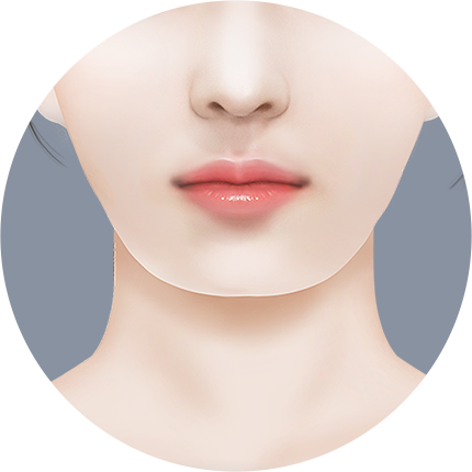 Mini V line Урд эрүүний мэс засал Angled эрүү