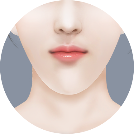 Mini V line Урд эрүүний мэс засал Муухай эрүү