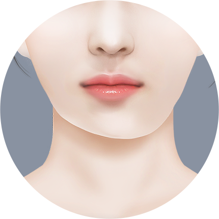 Mini V line Урд эрүүний мэс засал тэнцвэргүй эрүү