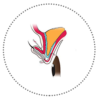 Нүд нээх булчин чангалах мэс засал Арьсан дотор утас оруулж