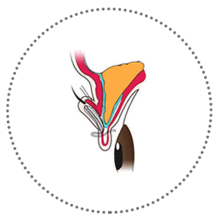 Нүд нээх булчин чангалах мэс засал Энэ нь байгалийн юм