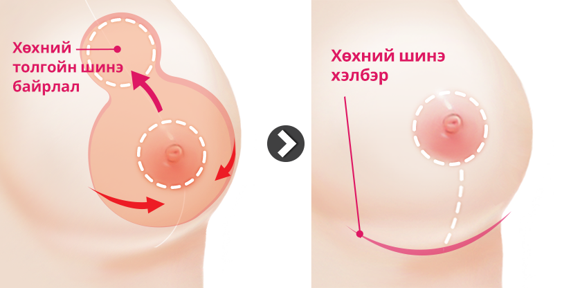 Хөх багасгах мэс засал босоо зүсэлтийн арга