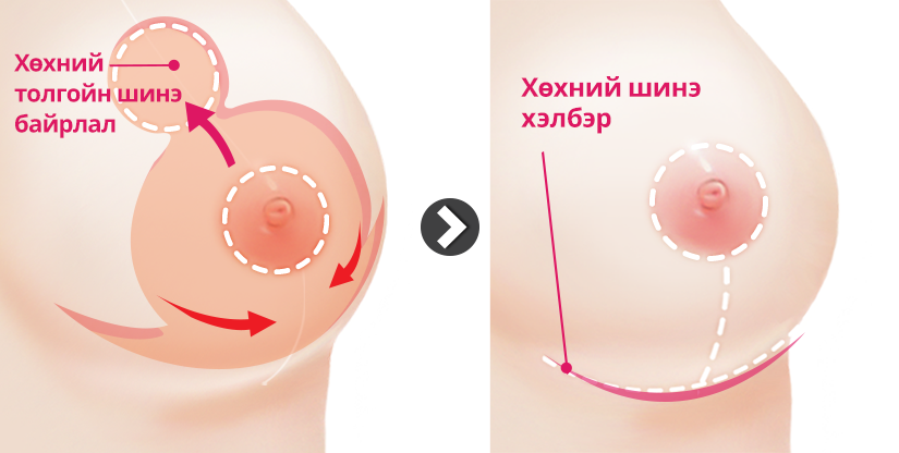 Хөх багасгах мэс засал зүсэлт хийх арга