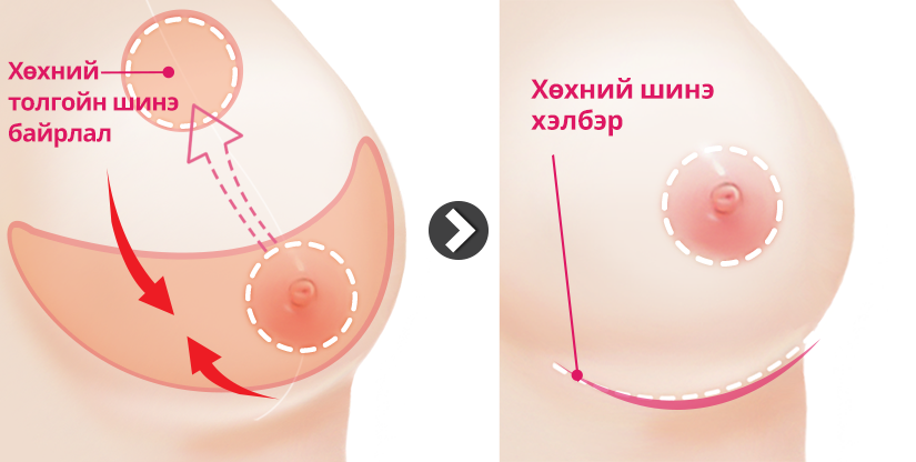 Хөх багасгах мэс засал Хөхний доор зүсэлт хийх арга