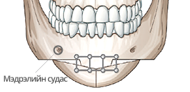 Урт нүүр богиносгох V line мэс засал Диамонд зүсэлт