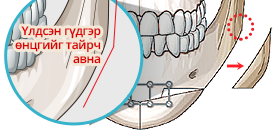 Урт нүүр богиносгох V line мэс засал Үлдсэн гүдгэр өнцгийг тайрч
