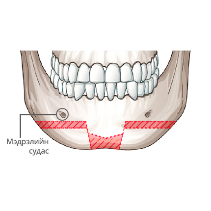 Урт нүүр богиносгох V line мэс засал Солонгос бренд Диамонд