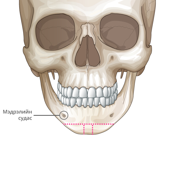 Mini V line Урд эрүүний мэс засал Мэдрэлийн