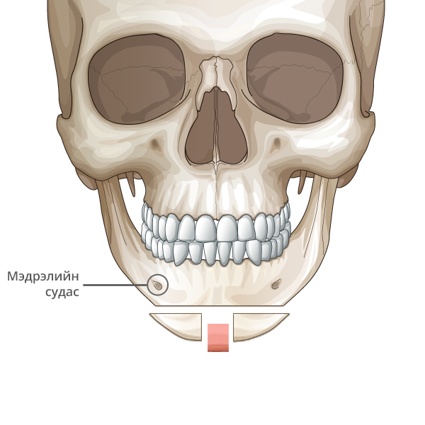 Mini V line Урд эрүүний мэс засал Ясны гол хэсгээс