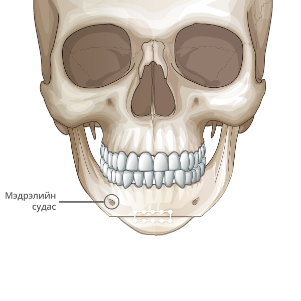 Mini V line Урд эрүүний мэс засал Эрүүний ясыг нийлүүлж