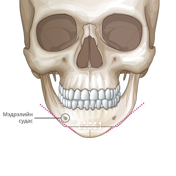 Mini V line Урд эрүүний мэс засал хэсгийг тайрна