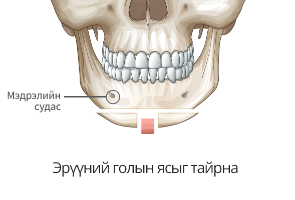 V line дөрвөлжин эрүүний мэс засал Т зүсэлттэй мэс заслын арга