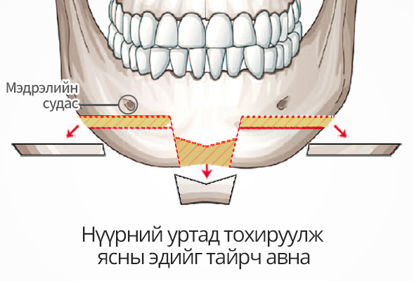 V line дөрвөлжин эрүүний мэс засал Диамонд хэлбэрийн зүсэлттэй мэс заслын арга