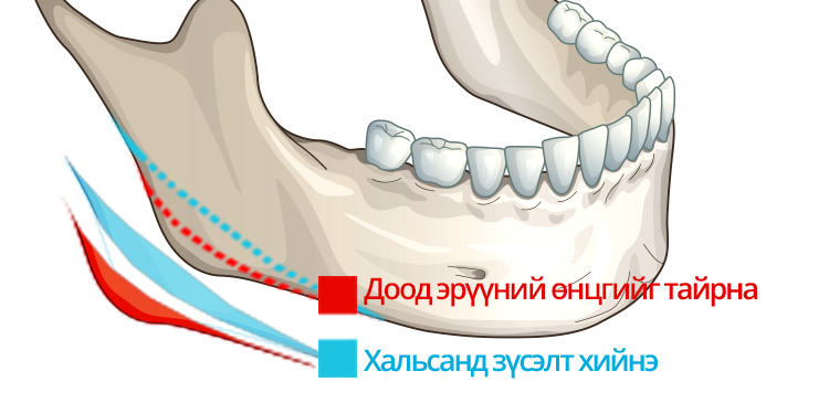 Урт нүүр богиносгох V line мэс засал Доод эрүүний өнцөг